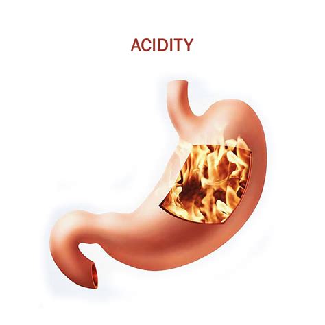 ACID REFLUX